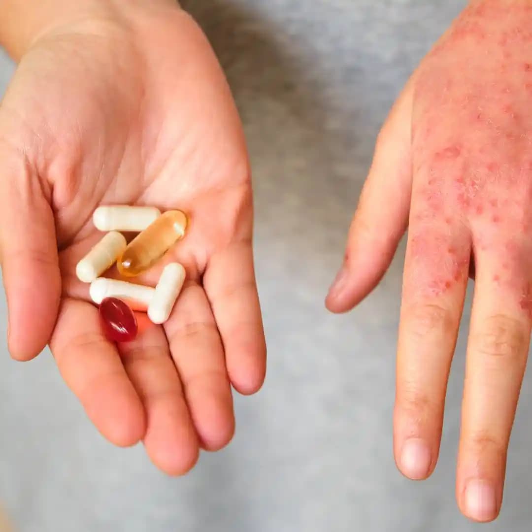 Eczanede Hazırlanan Uyuz İlaçlarının Avantajları ve Uygulama Süreci