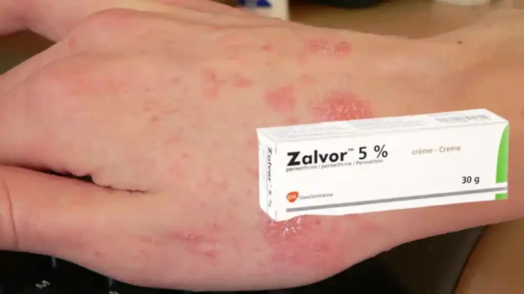 En Etkili Uyuz İlacı Seçenekleri ve Tedavi Yöntemleri Hakkında Detaylı Bilgi