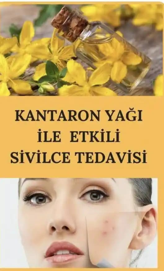 Sivilceye Karşı Kantaron Yağı: Doğal ve Güvenli Bir Cilt Tedavi Seçeneği