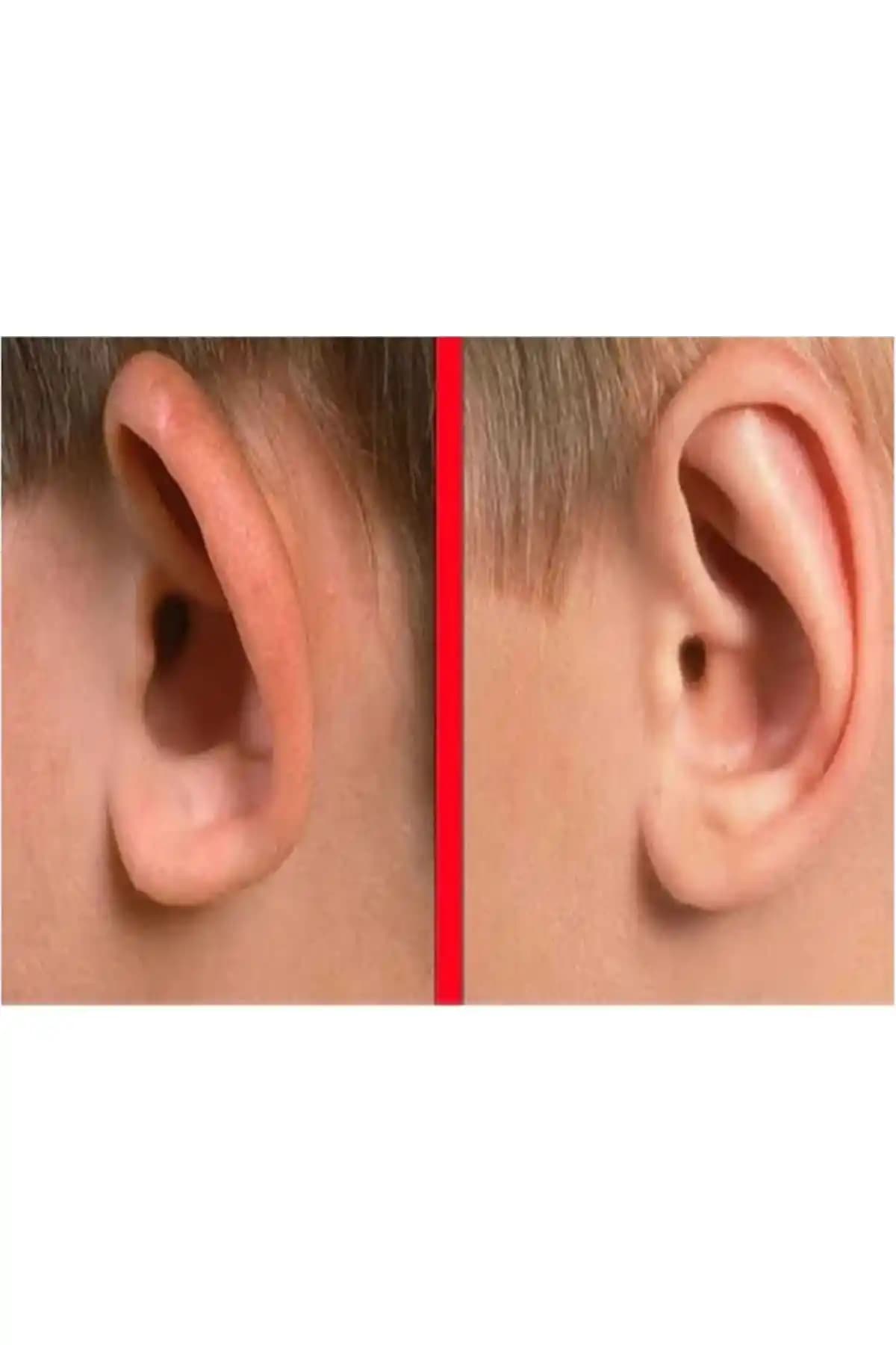 Inobag Şeffaf Çift Taraflı Kepçe Kulak Düzeltme Bandı İncelemesi ve Kullanım Rehberi